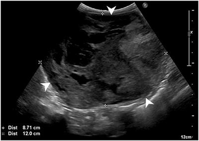 Resolution of paraneoplastic hypoglycemia following nephroureterectomy for treatment of canine renal cell carcinoma: Case report
